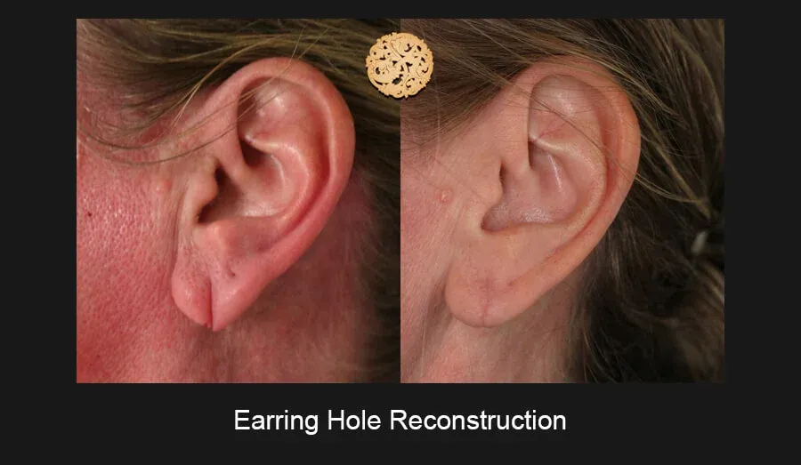Earring Hole Reconstruction Before & After
