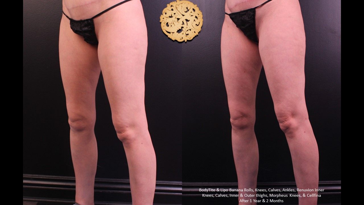 Renuvion Before & After