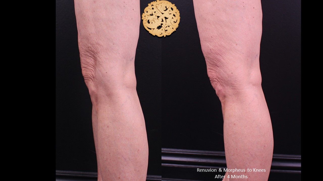Renuvion Before & After