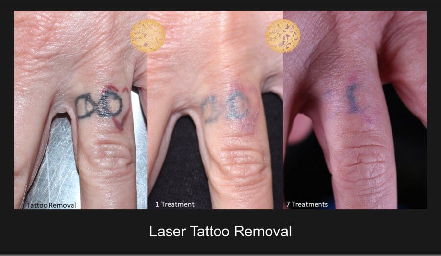 PicoSure Before & After