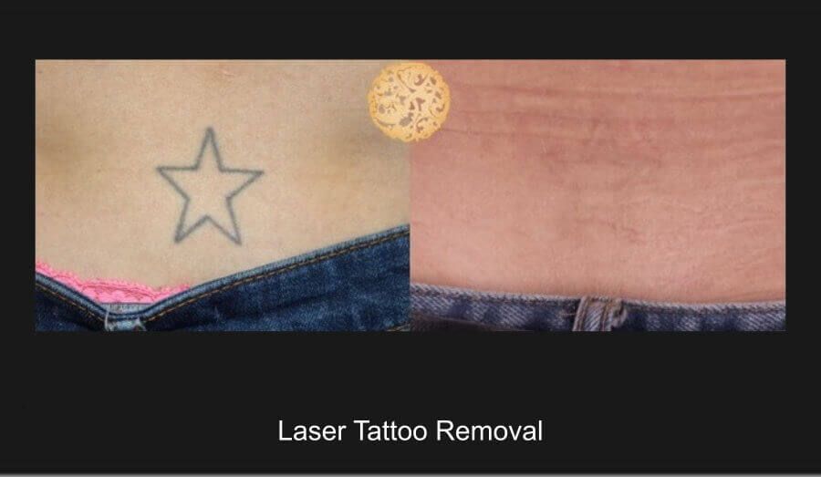 PicoSure Before & After