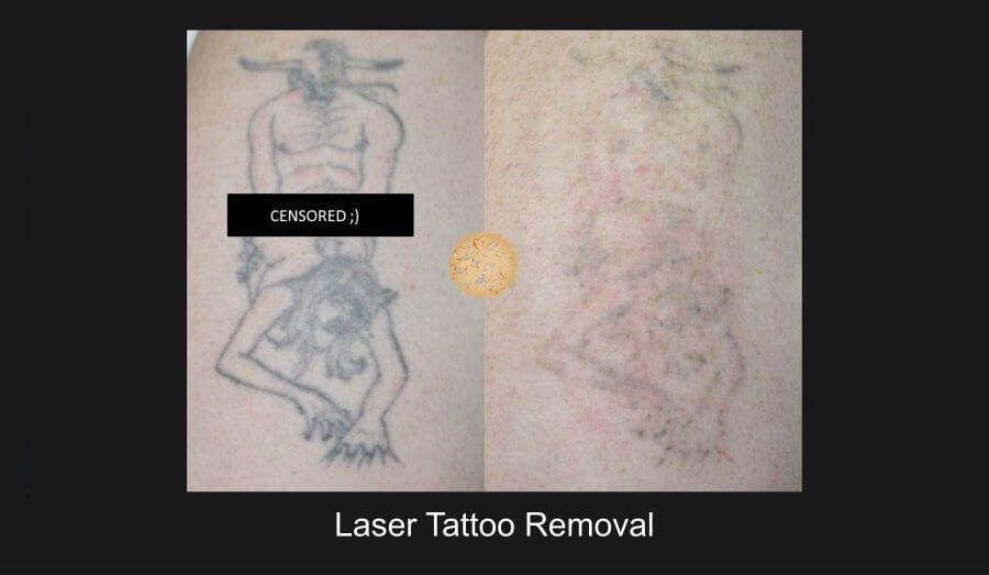 PicoSure Before & After