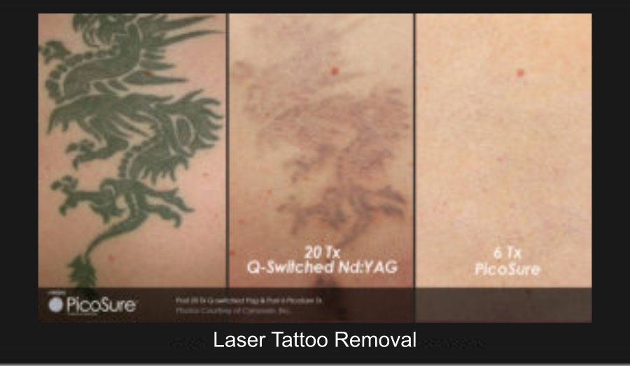 PicoSure Before & After