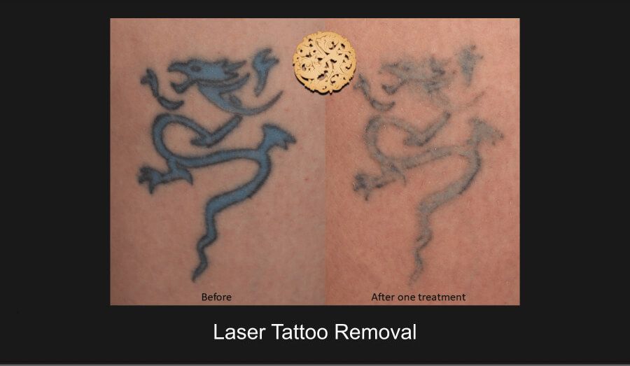 PicoSure Before & After