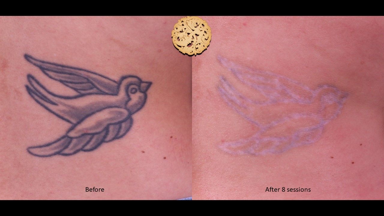 PicoSure Before & After