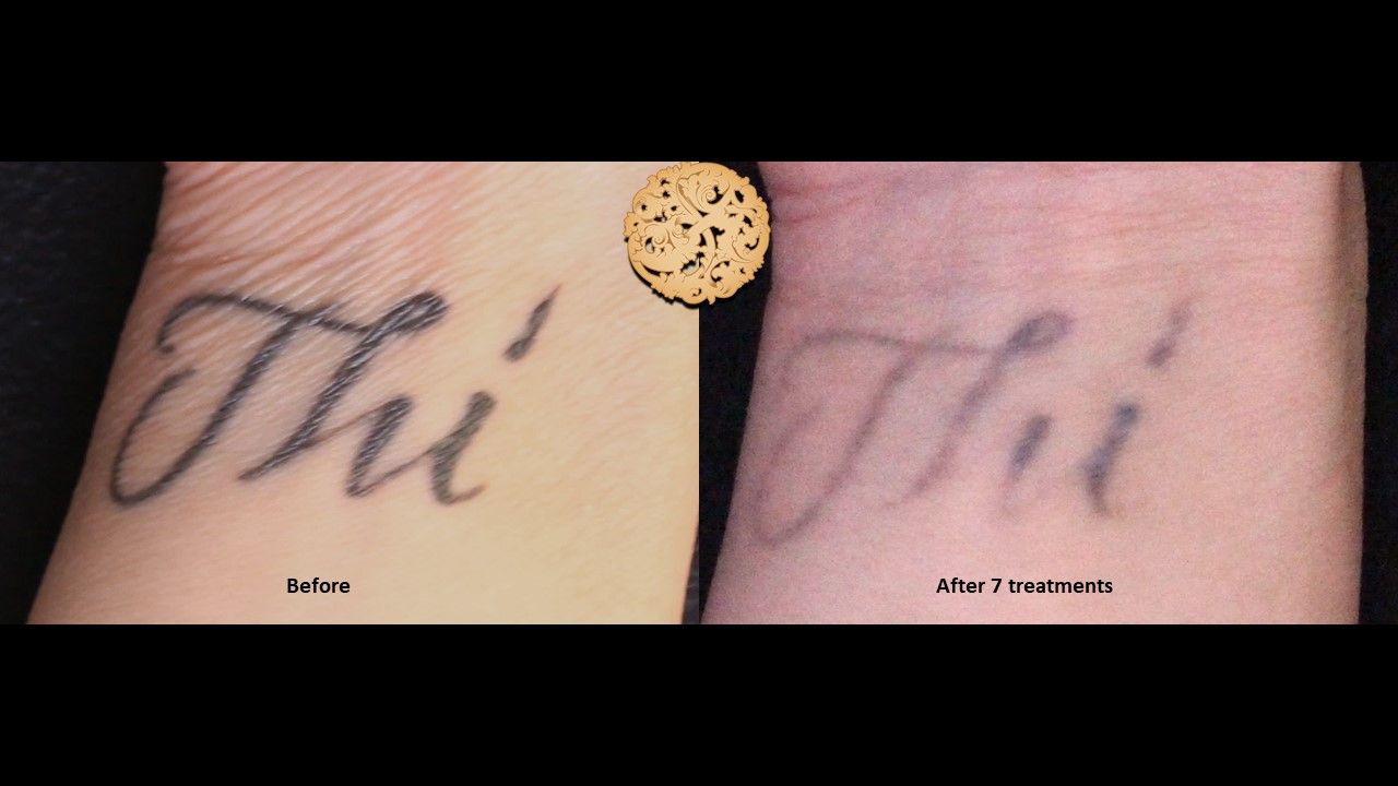 PicoSure Before & After