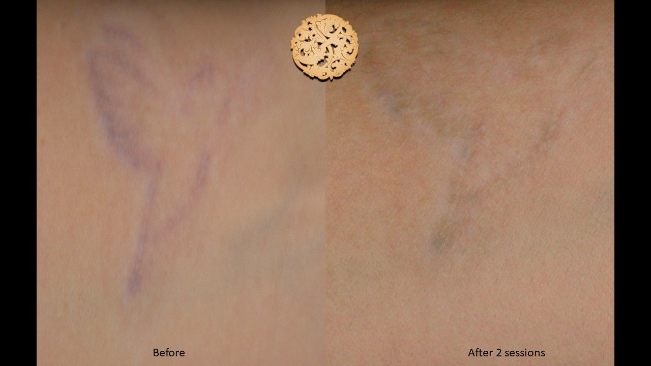 PicoSure Before & After