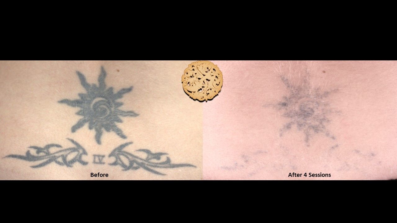 PicoSure Before & After