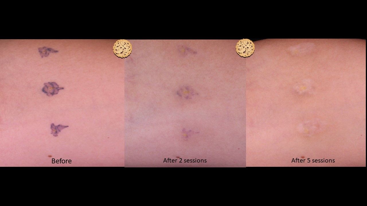 PicoSure Before & After