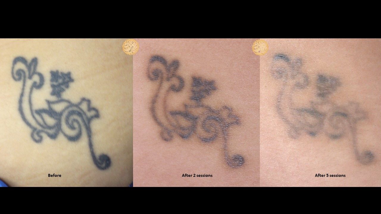 PicoSure Before & After