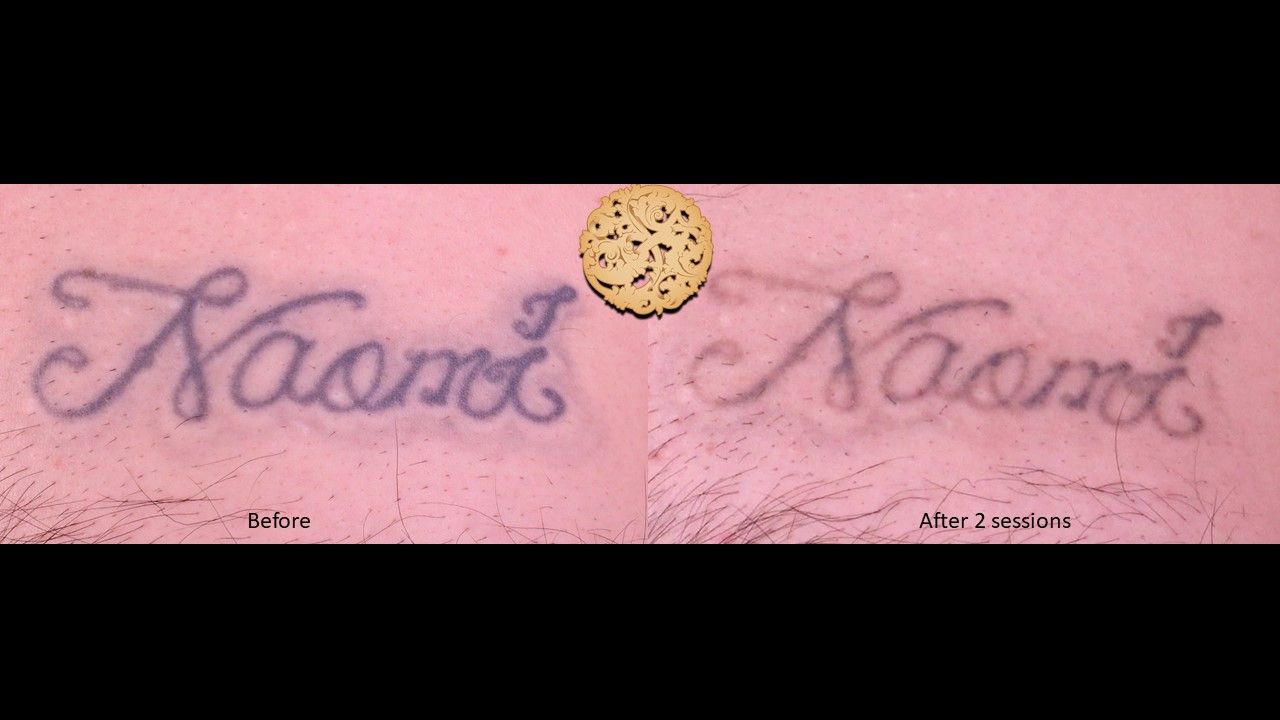 PicoSure Before & After