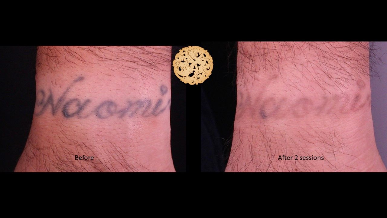 PicoSure Before & After