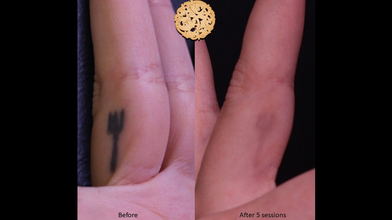 PicoSure Before & After