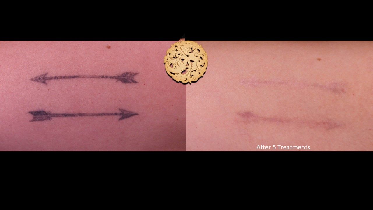 PicoSure Before & After