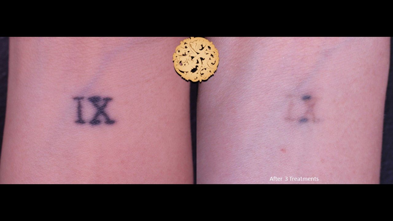 PicoSure Before & After