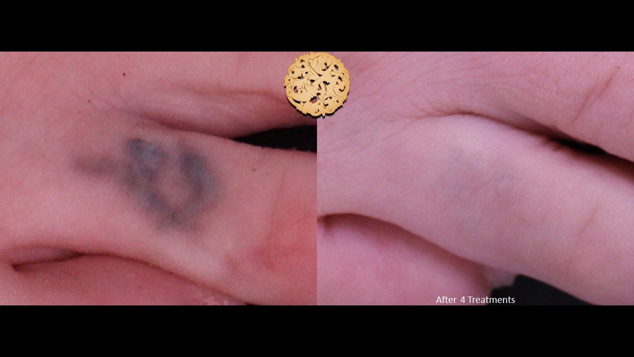 PicoSure Before & After