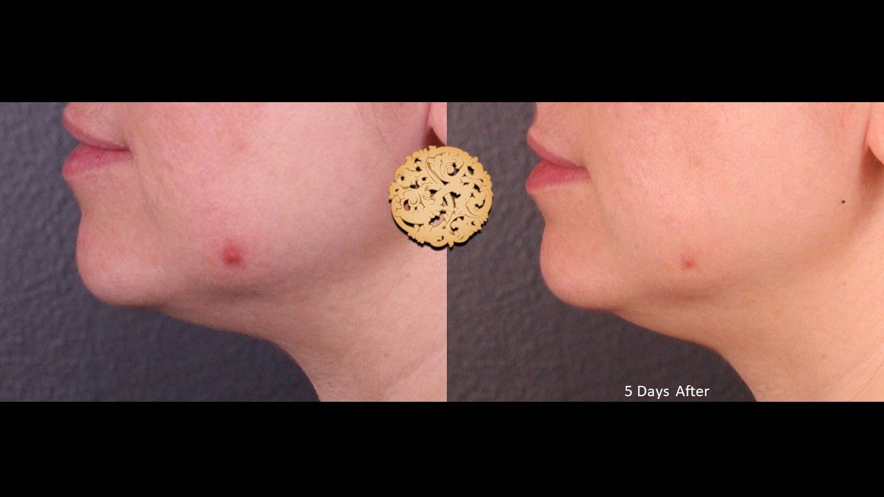 Kenalog Before & After