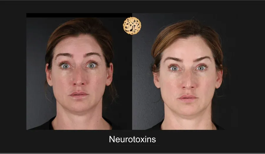 Neurotoxins Before & After