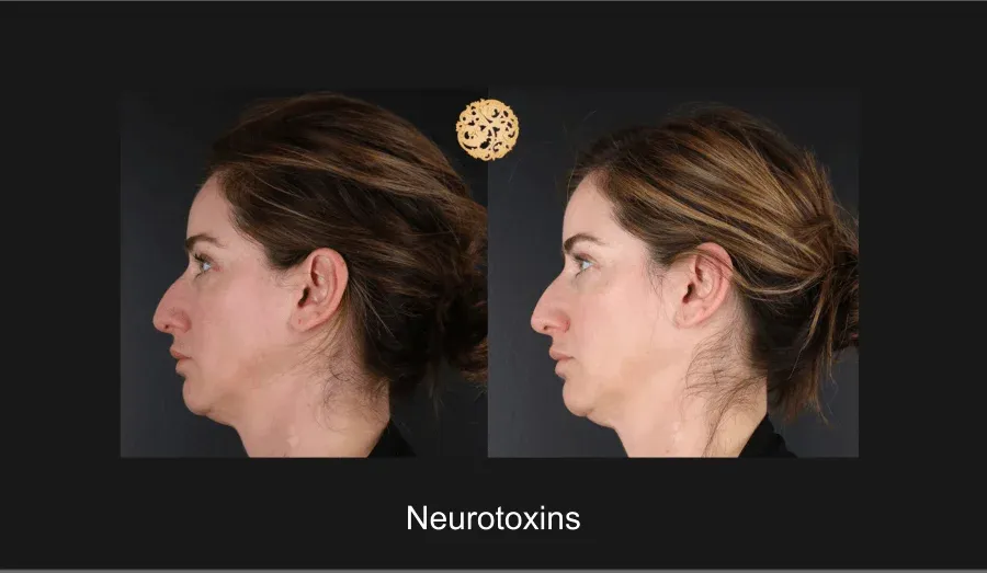 Neurotoxins Before & After