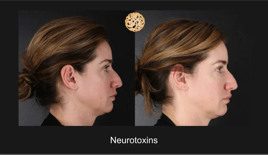 Neurotoxins Before & After