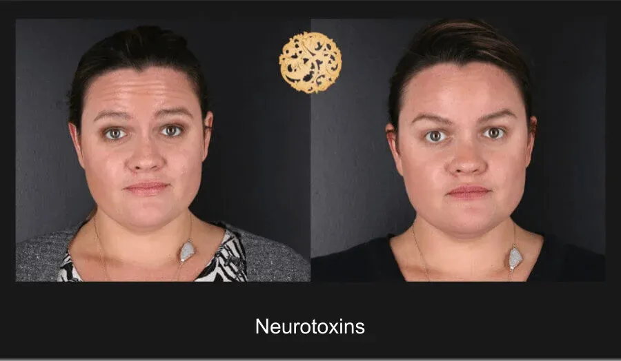 Neurotoxins Before & After