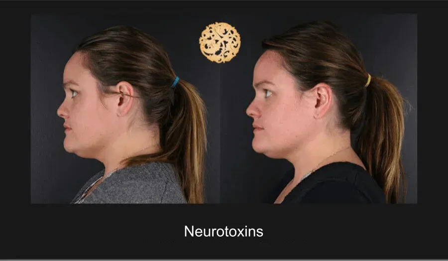 Neurotoxins Before & After