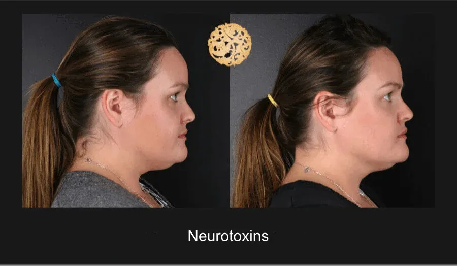 Neurotoxins Before & After