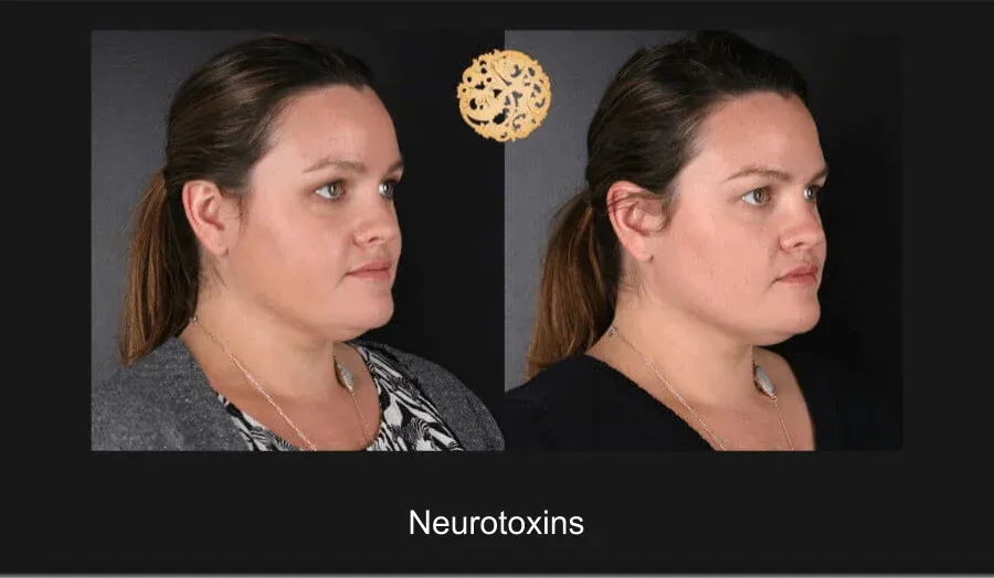 Neurotoxins Before & After