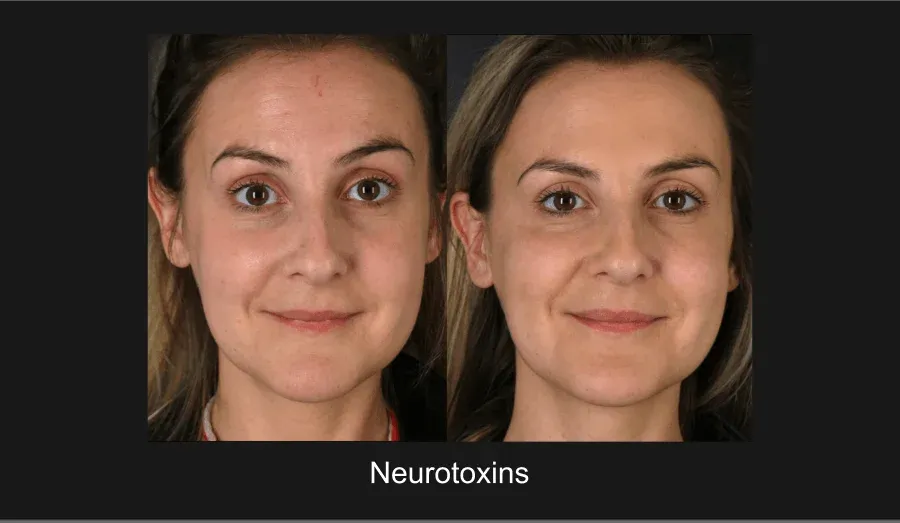 Neurotoxins Before & After