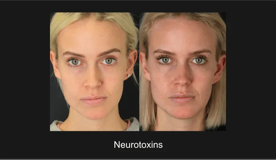 Neurotoxins Before & After