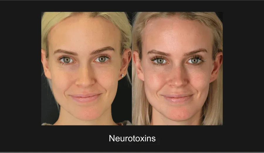 Neurotoxins Before & After