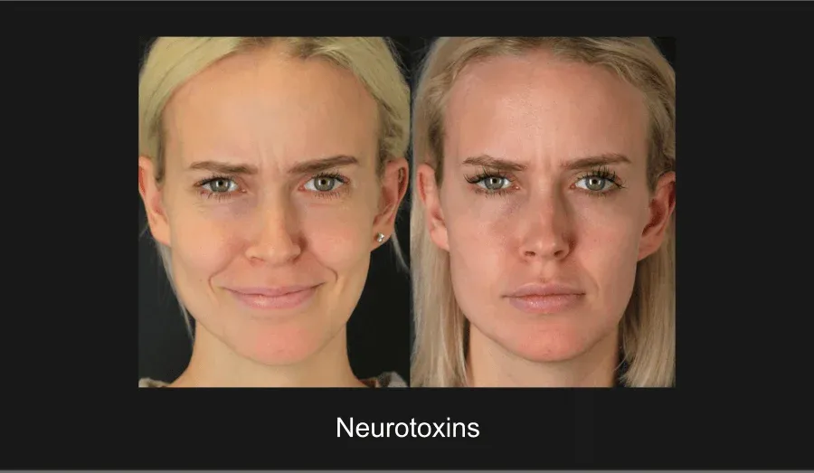 Neurotoxins Before & After