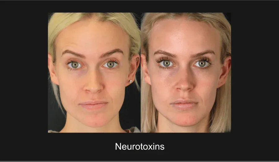 Neurotoxins Before & After