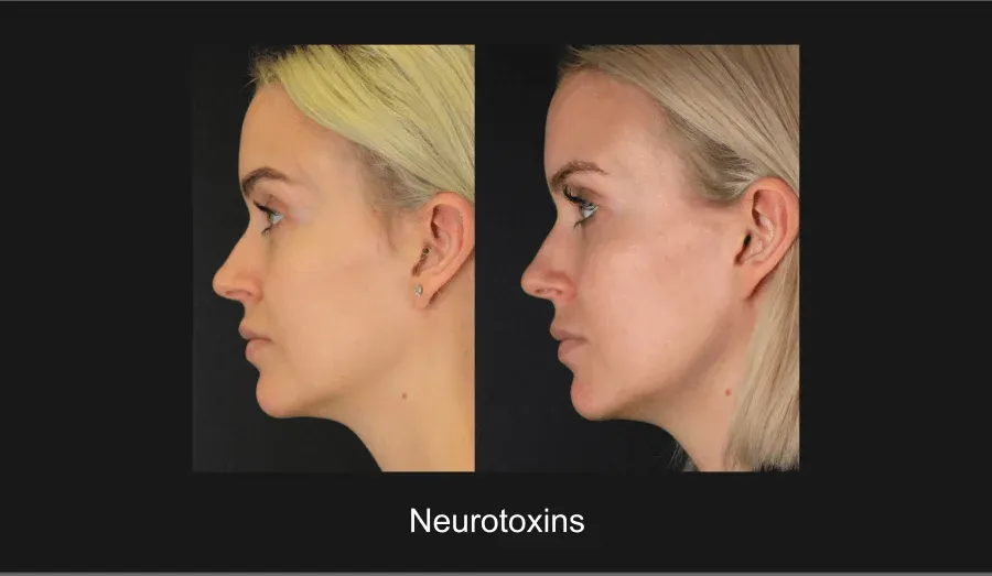 Neurotoxins Before & After
