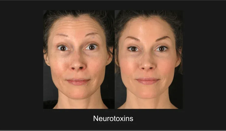 Neurotoxins Before & After