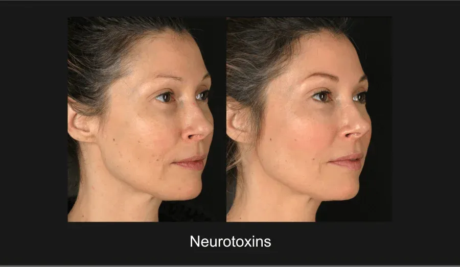 Neurotoxins Before & After
