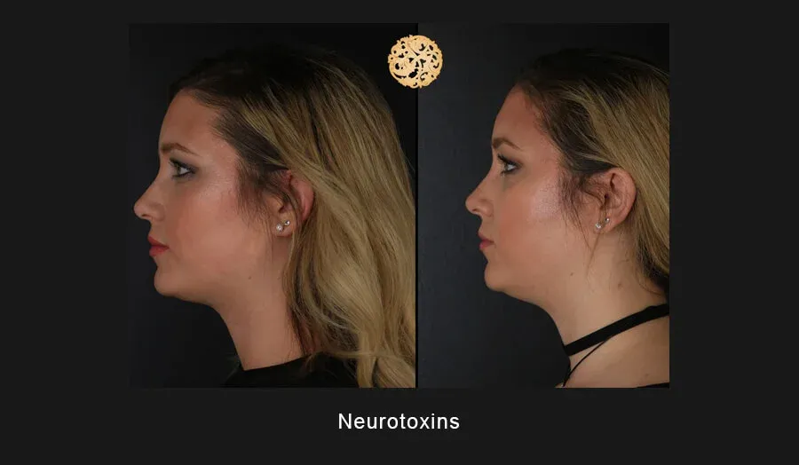 Neurotoxins Before & After
