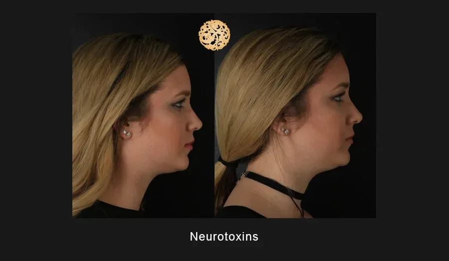 Neurotoxins Before & After