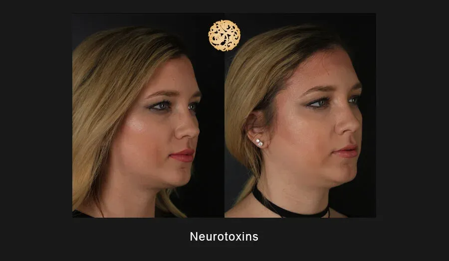 Neurotoxins Before & After