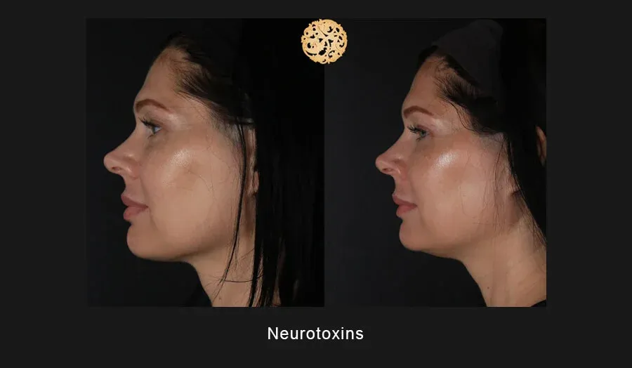 Neurotoxins Before & After