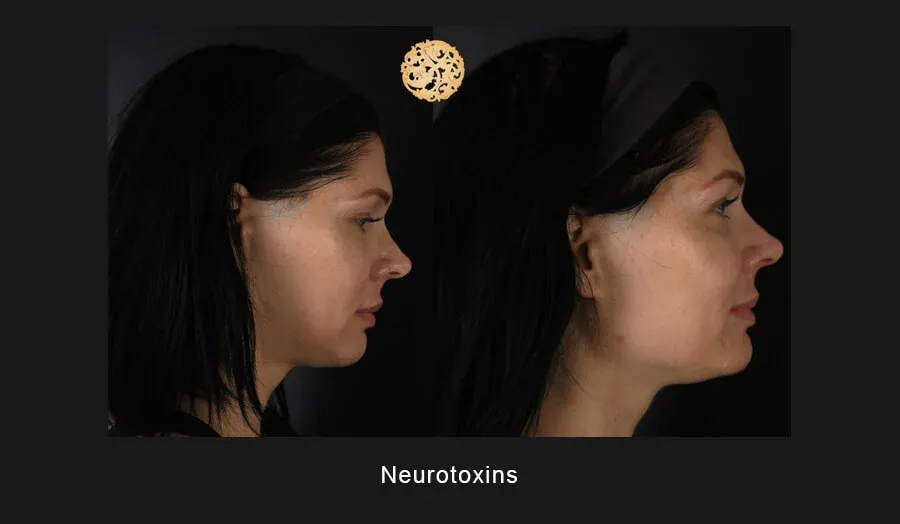 Neurotoxins Before & After