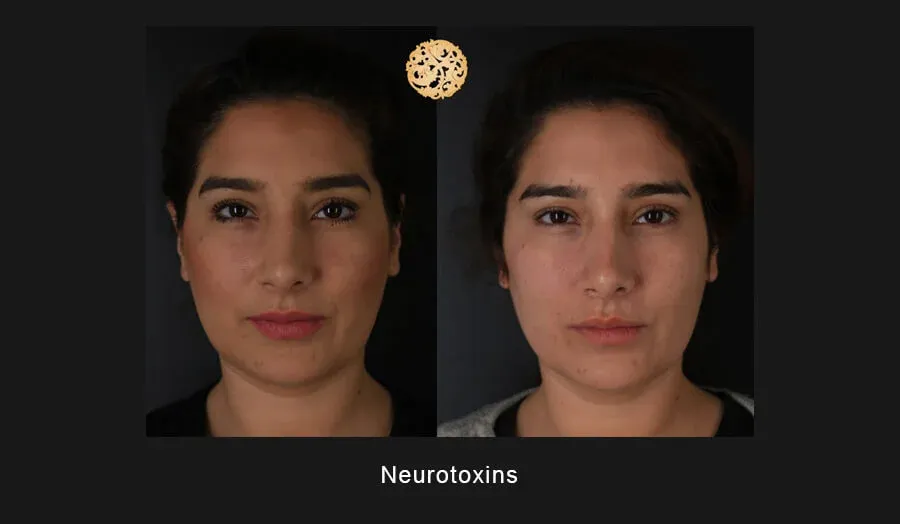 Neurotoxins Before & After