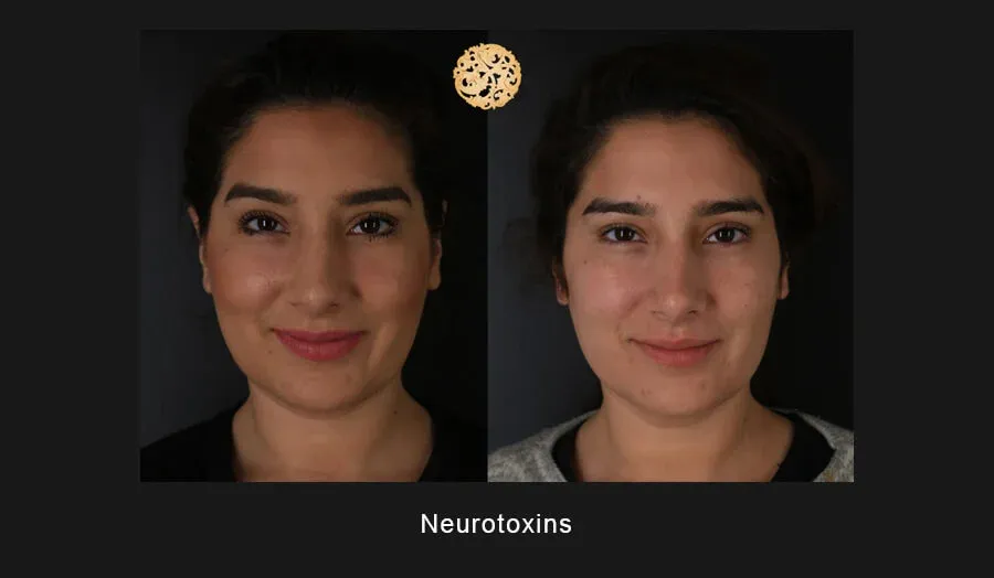 Neurotoxins Before & After