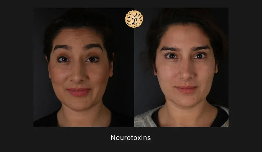 Neurotoxins Before & After