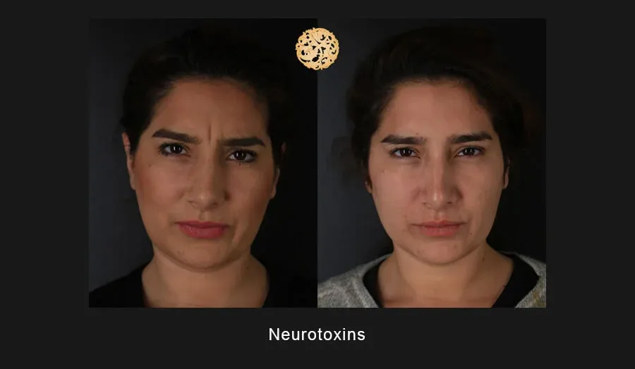 Neurotoxins Before & After