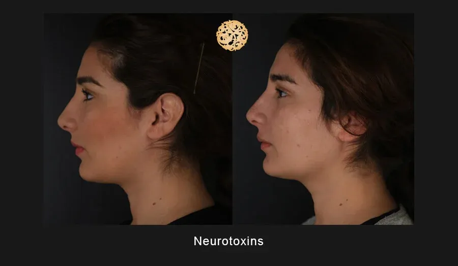 Neurotoxins Before & After