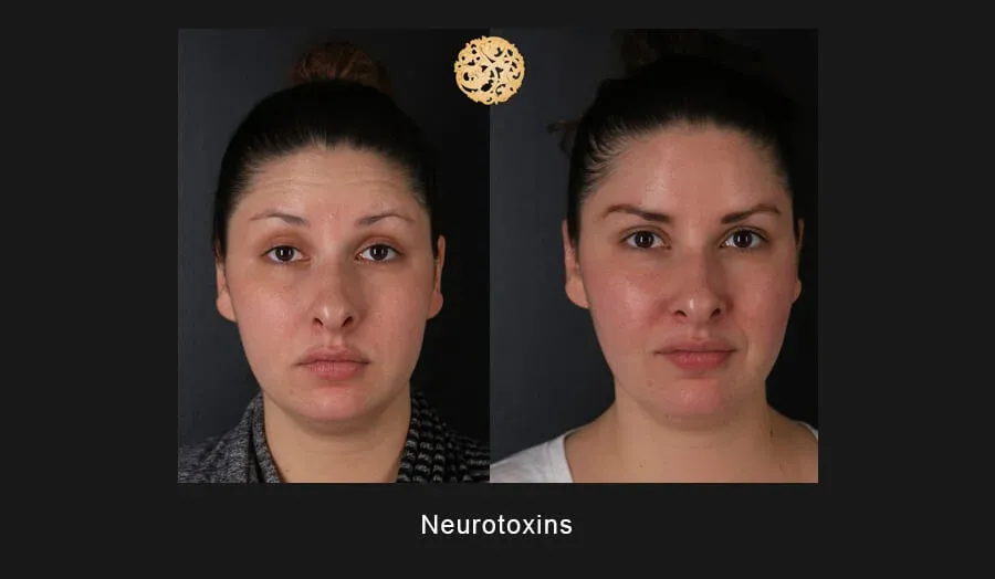 Neurotoxins Before & After