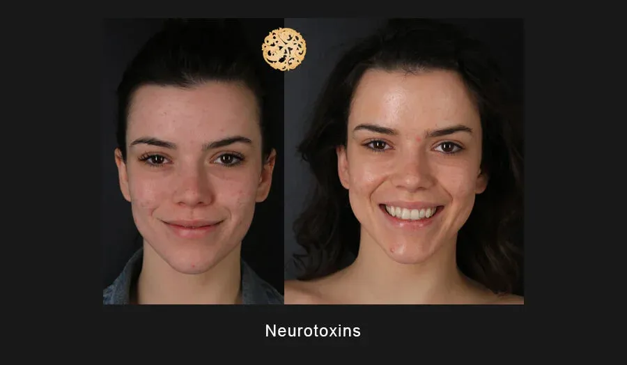 Neurotoxins Before & After