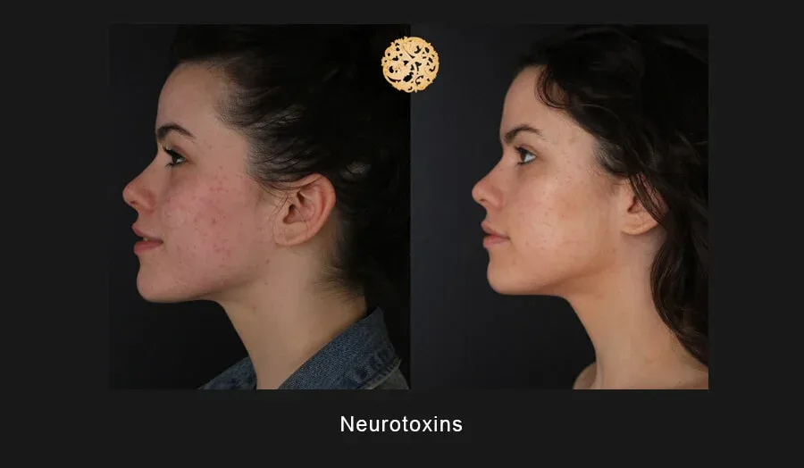 Neurotoxins Before & After