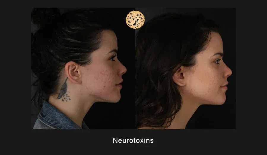 Neurotoxins Before & After